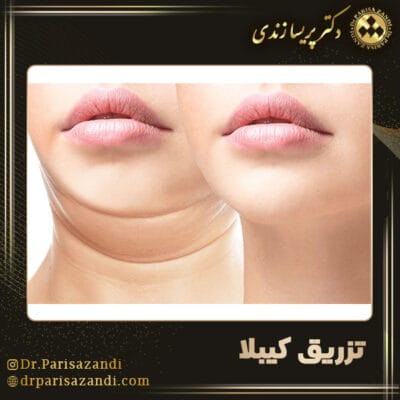 تزریق کیبلا