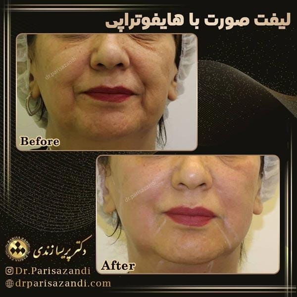 هایفوتراپی- دکتر زندی