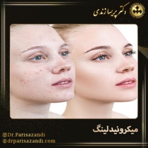 میکرونیدلینگ - دکتر زندی