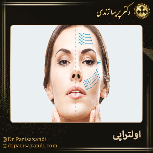 اولتراپی