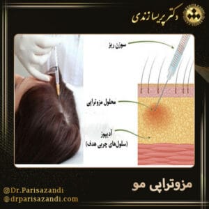 مزوتراپی مو - دکتر زندی