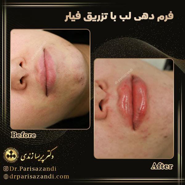 عکس قبل و بعد تزریق ژل لب