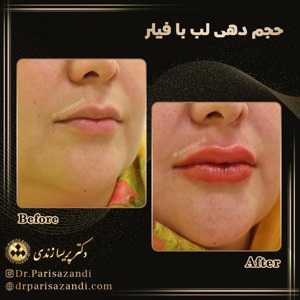 عکس قبل و بعد تزریق ژل لب