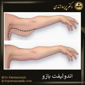 اندولیفت بازو | دکتر پریسا زندی