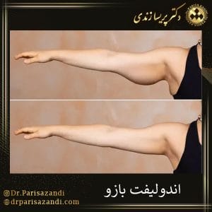 اندولیفت بازو | دکتر پریسا زندی