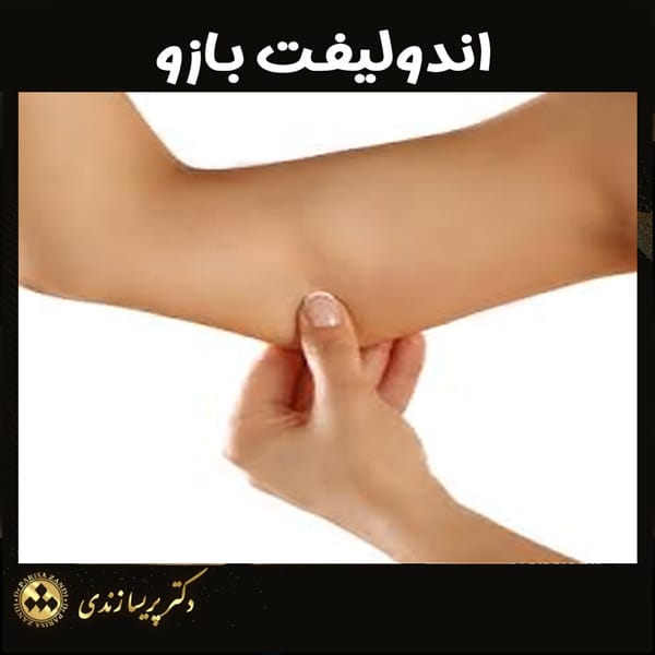 اندولیفت بازو