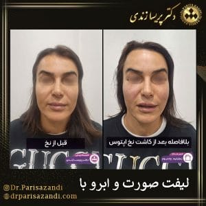 لیفت صورت و ابرو با نخ | دکتر پریسا زندی