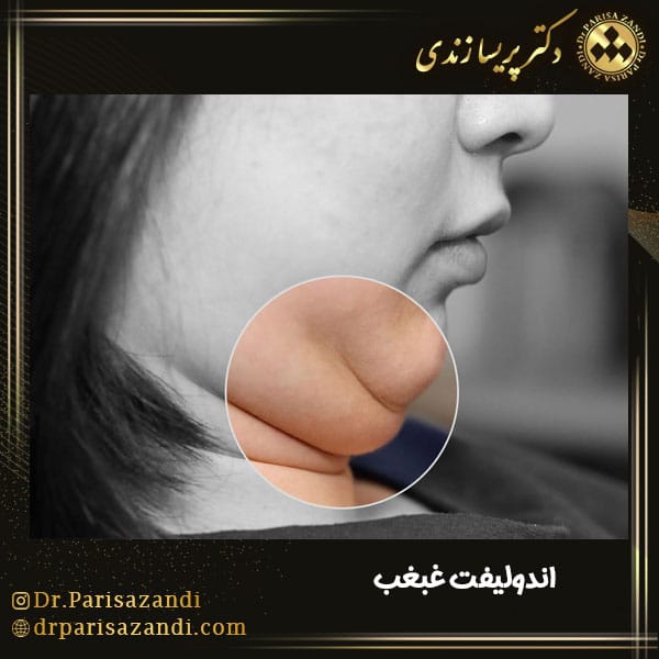 رفع غبغب با اندولیفت