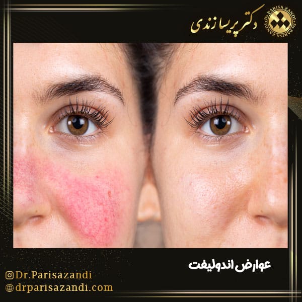 قرمزی از عوارض اندولیفت صورت 