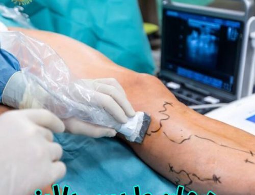 درمان واریس با لیزر