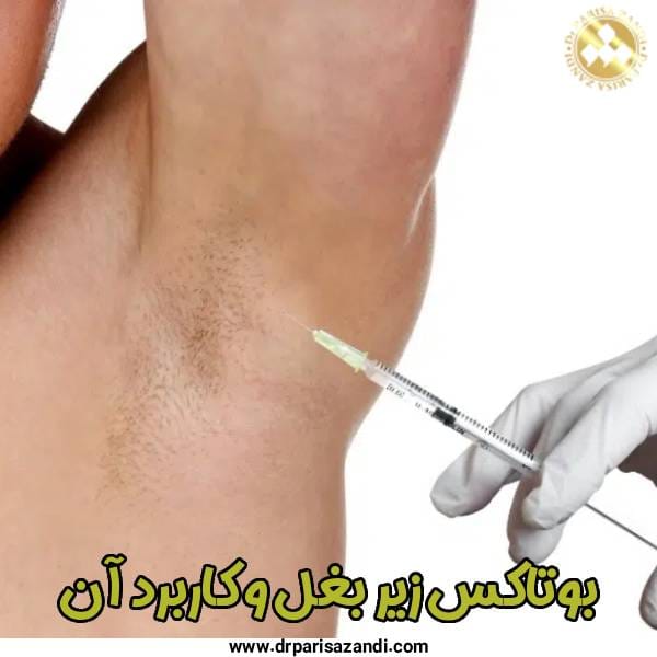 بوتاکس زیر بغل - دکتر پریسا زندی