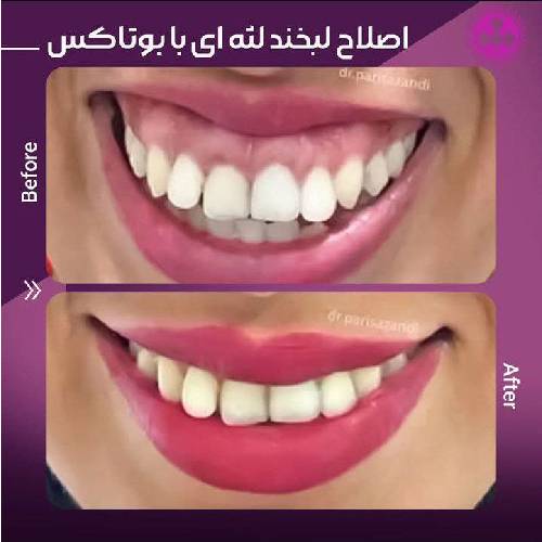 تزریق-بوتاکس-5