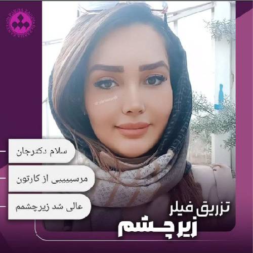 تزریق-فیلر-52
