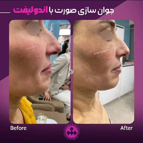 جوانسازی-صورت-اندولیفت