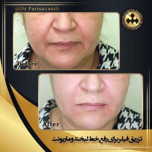 تزریق-فیلر-1