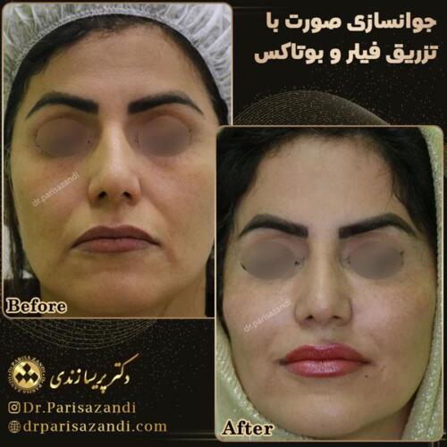 تزریق-فیلر-12