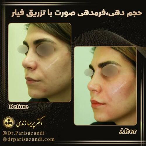 تزریق-فیلر-17