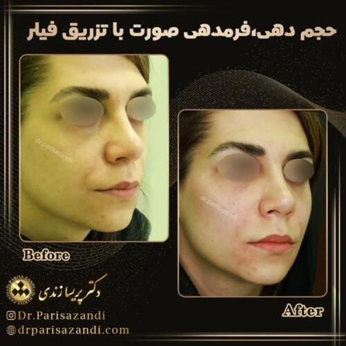 تزریق-فیلر-18