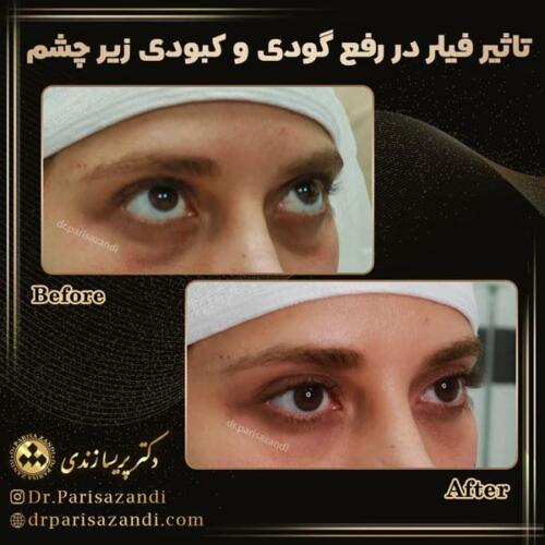 تزریق-فیلر-19