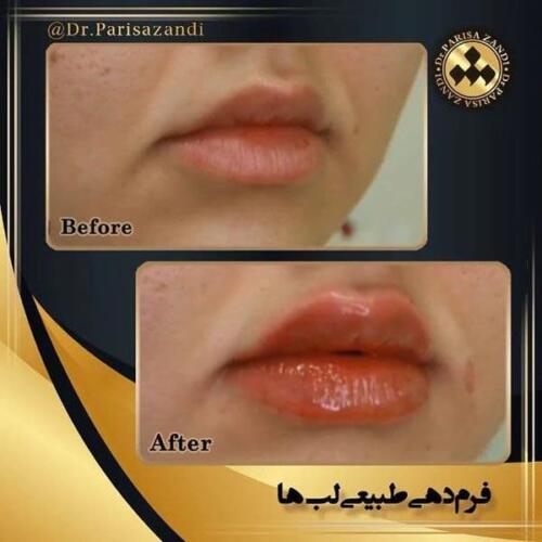 تزریق-فیلر-2