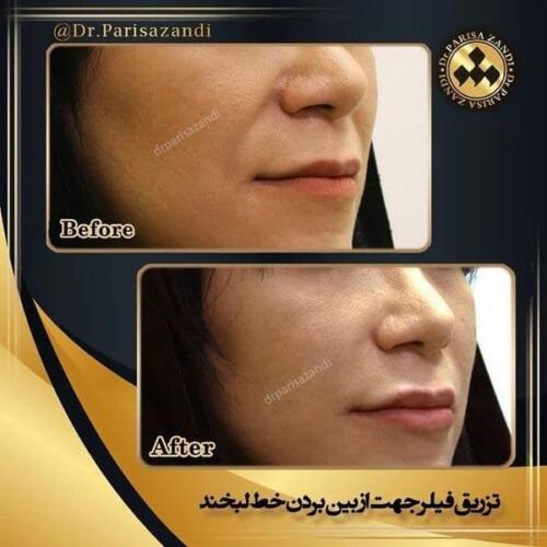 تزریق-فیلر-3