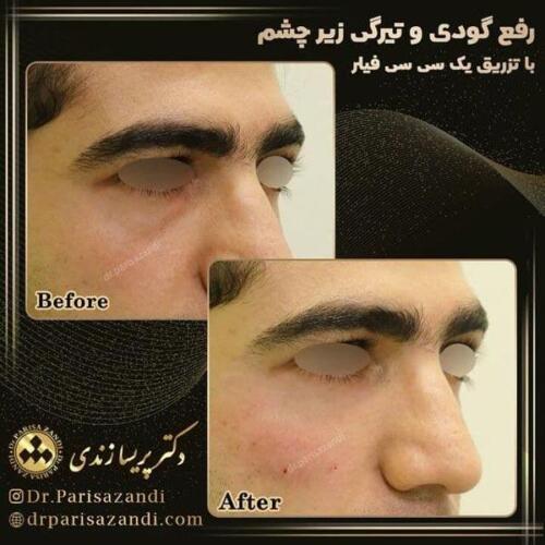 تزریق-فیلر-5