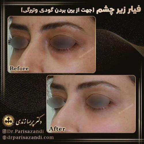 تزریق-فیلر-7