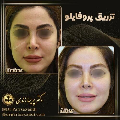 تزریق-پروفایلو-4