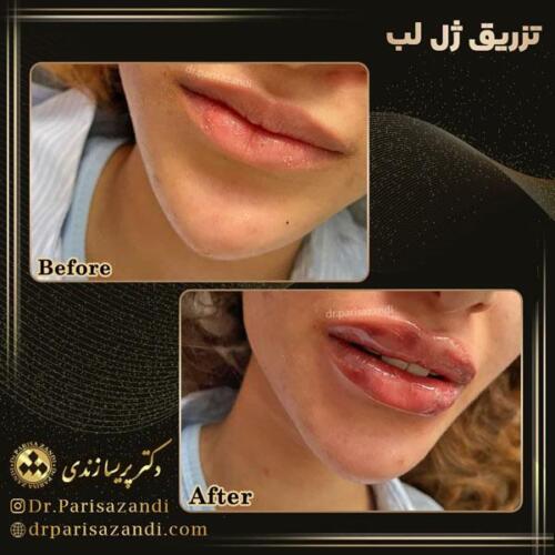 تزریق-ژل-5